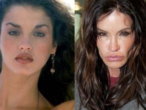 Janice Dickinson before and after plastic surgery 01