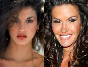 Janice Dickinson before and after plastic surgery 02