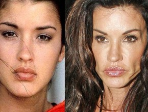 Janice Dickinson before and after plastic surgery