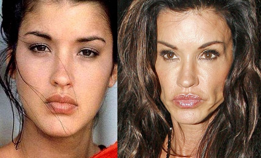 Janice Dickinson before and after plastic surgery