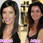 Janice Dickinson before and after plastic surgery 04