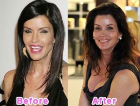 Janice Dickinson before and after plastic surgery 04