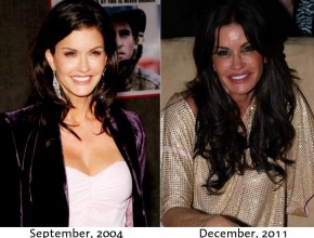 Janice Dickinson before and after plastic surgery 05