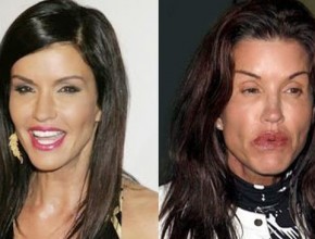 Janice Dickinson before and after plastic surgery