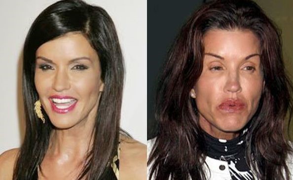 Janice Dickinson before and after plastic surgery.