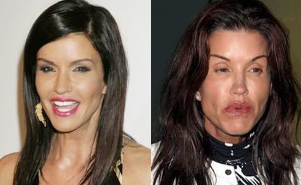 Janice Dickinson before and after plastic surgery