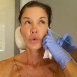 Janice Dickinson plastic surgery botox injections