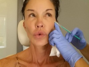 Janice Dickinson plastic surgery botox injections