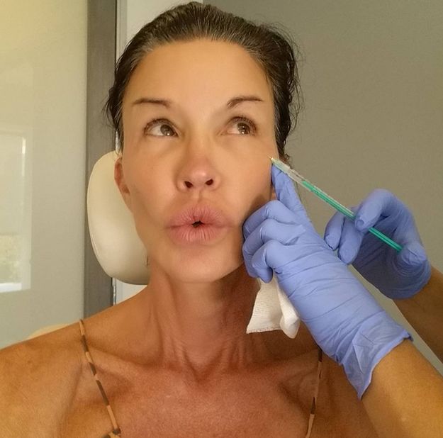 Janice Dickinson plastic surgery botox injections