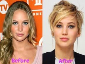 Jennifer Lawrence before and after plastic surgery 02