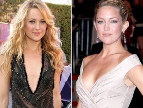 Kate Hudson before and after Plastic surgery