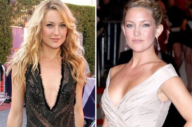 Kate Hudson before and after Plastic surgery