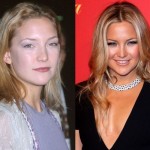 Kate Hudson before and after Plastic surgery 02