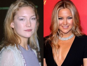 Kate Hudson before and after Plastic surgery 02