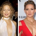 Kate Hudson before and after Plastic surgery 03