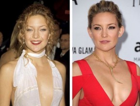 Kate Hudson before and after Plastic surgery 03