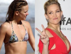 Kate Hudson before and after Plastic surgery 05