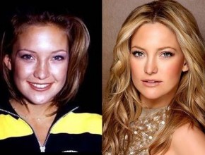 Kate Hudson before and after Plastic surgery