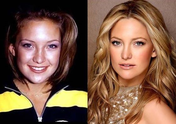 Kate Hudson before and after Plastic surgery