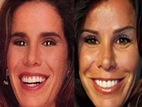 Melisa Rivers before and after plastic surgery
