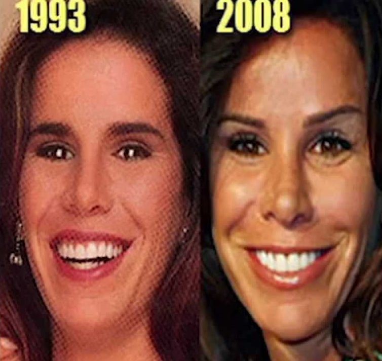 Melisa Rivers before and after plastic surgery