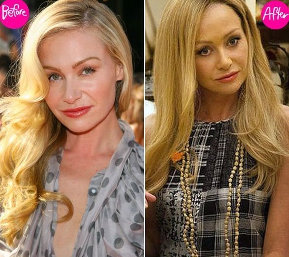 Portia De Rossi before and after plastic surgery