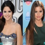 Selena Gomez before and after plastic surgery 01