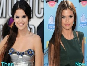 Selena Gomez before and after plastic surgery 01