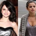 Selena Gomez before and after plastic surgery 06