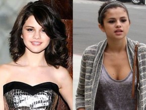 Selena Gomez before and after plastic surgery 06