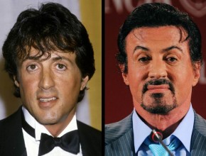 Sylvester Stallone before and after plastic surgery