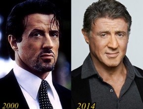 Sylvester Stallone before and after plastic surgery 08
