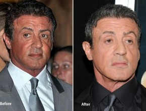 Sylvester Stallone before and after plastic surgery