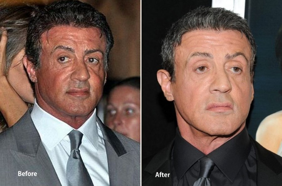 Sylvester Stallone before and after plastic surgery