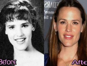 Jennifer Garner before and after plastic surgery