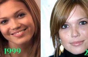 Mandy Moore before and after plastic surgery