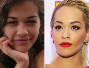 Rita Ora before and after plastic surgery