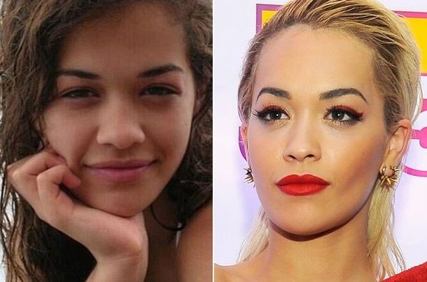 Rita Ora before and after plastic surgery