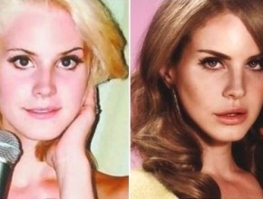 Lana Del Rey before and after plastic surgery