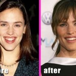 Jennifer Garner before and after plastic surgery