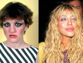 Courtney Love before and after plastic surgery