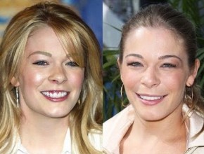 LeAnn Rimes before and after plastic surgery