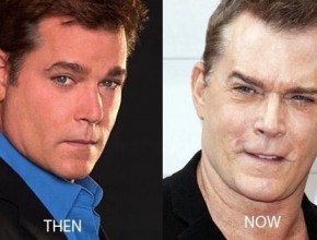 Ray Liotta before and after plastic surgery