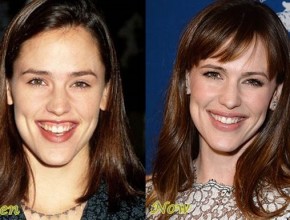 Jennifer Garner before and after plastic surgery