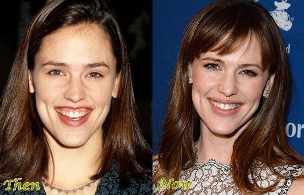 Jennifer Garner before and after plastic surgery