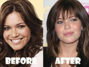 Mandy Moore before and after plastic surgery