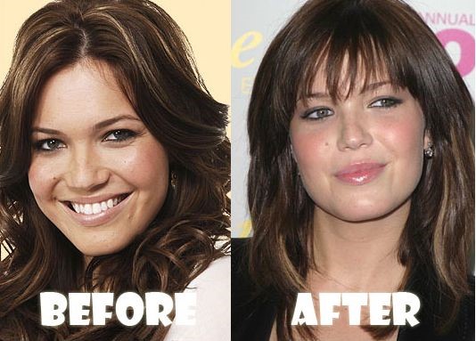 Mandy Moore before and after plastic surgery