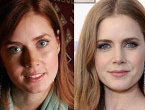 Amy Adams before and after plastic surgery