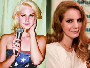 Lana Del Rey before and after plastic surgery