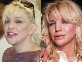 Courtney Love before and after plastic surgery
